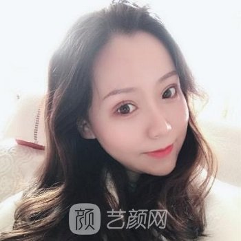 双眼皮全切七天修复图，修复期也要美美的！