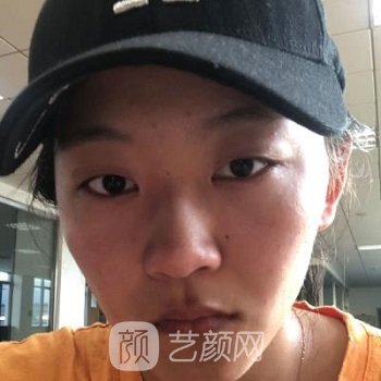 芭比眼综合图片前后对比，变成人间水蜜桃，如此简单