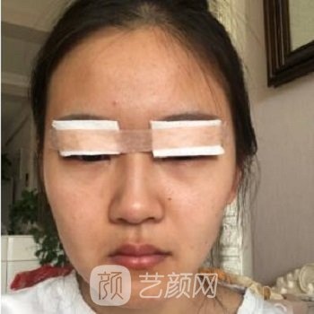 芭比眼综合图片前后对比，变成人间水蜜桃，如此简单