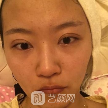 芭比眼综合图片前后对比，变成人间水蜜桃，如此简单