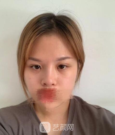 李天石双眼皮修复实例,妈生款美丽双眼皮塑造