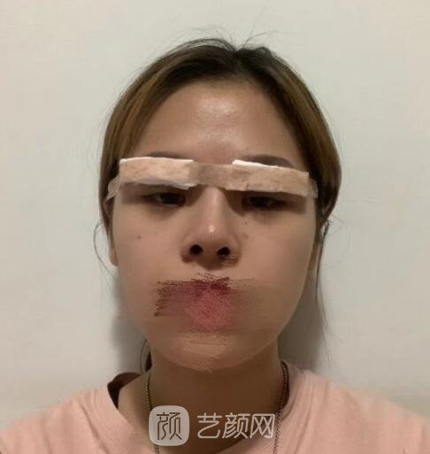 李天石双眼皮修复实例,妈生款美丽双眼皮塑造