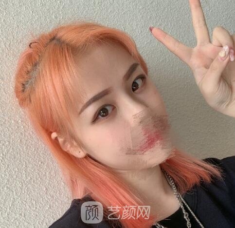 李天石双眼皮修复实例,妈生款美丽双眼皮塑造