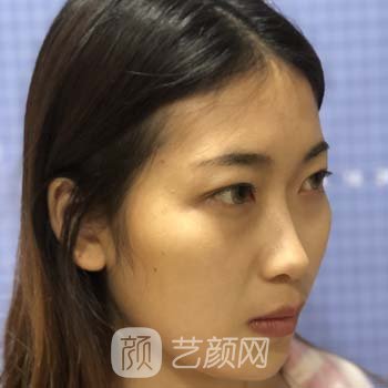 孟庆鹏做鼻子怎么样？多少钱?隆鼻实例：打造氧气美女