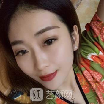 王军隆鼻失败修复实例，修复之后鼻子变得迷人又精致