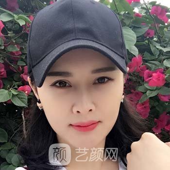 长沙吴蒙隆鼻实例，医生技术如何？全在手术修复过程图中展示