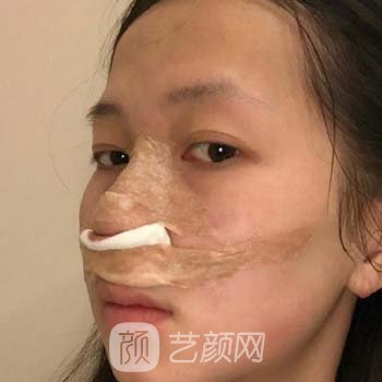 周栩隆鼻真人实例，隆鼻之后秒变仙女，真是不要太美