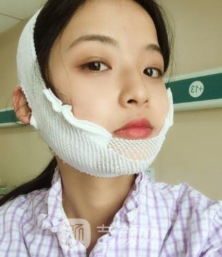 洪兴范磨骨实例，转眼就成了360度无死角美女