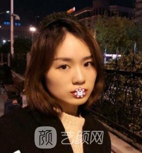 朱石江颌面手术怎么样？医生简介+下颌角磨骨实例