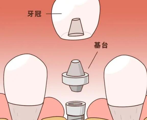 牙齿种植动漫57.jpg