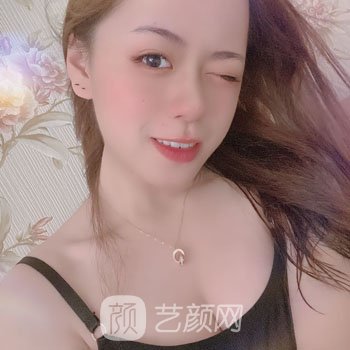 华美宋晓东隆胸失败修复实例，术后变得更加自信有魅力