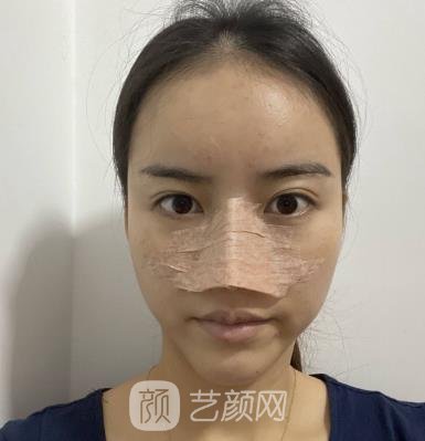 南京施尔美刘道功隆鼻价格实例对比图，真人修复一览