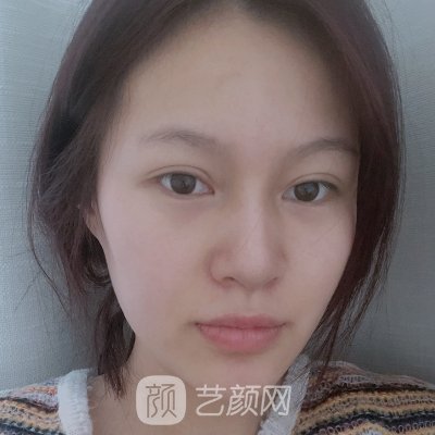 泸州韩美整形医院正规吗？全新双眼皮实例出炉