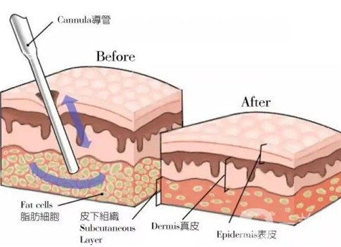 水动力吸脂有什么优点？会留疤吗