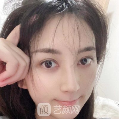 西安画美杨万忠做鼻子怎么样?亲身体验案例公开