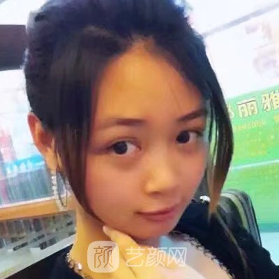 贵阳利美康整形美容医院隆鼻案例展示|效果自然美观