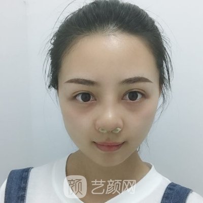 贵阳利美康整形美容医院隆鼻案例展示|效果自然美观