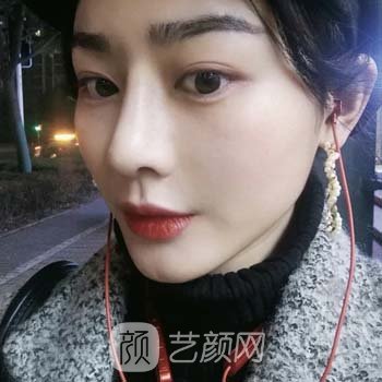 戴传昌做鼻子真人实例，术后30天简直美炸了