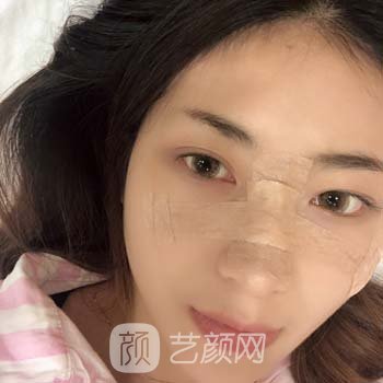 崔永言做鼻子多少钱？医生个人简介+假体隆鼻实例对比图