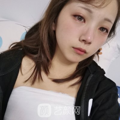 徐州华美整形医院隆胸实例公开｜80天体验成果图公布