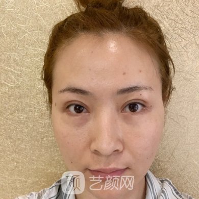 沈阳美莱美容整形医院除皱瘦脸实例公开|成果自然美观