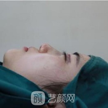 成都高富雷医生隆鼻实例，鼻子高挺了，面部更立体