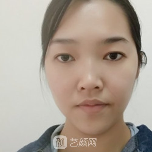 南京华美除皱抗衰实例发布｜体验前后对比图出炉