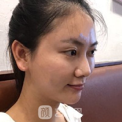 东方瑞丽整形美容医院全新隆鼻实例展示｜这是你想要的成果吗？