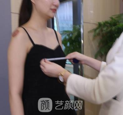 杨迪院长假体隆胸实例，术后展现胸部迷人魅力