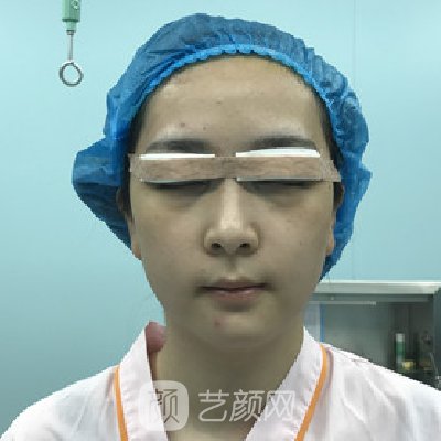 郑州集美做双眼皮怎么样?医院招牌实例曝光