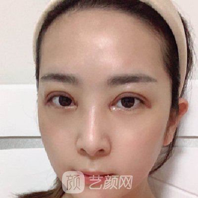 郑州集美做双眼皮怎么样?医院招牌实例曝光