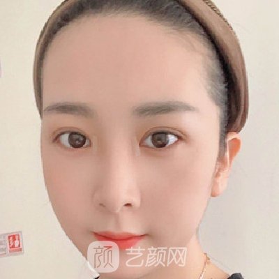 郑州集美做双眼皮怎么样?医院招牌实例曝光