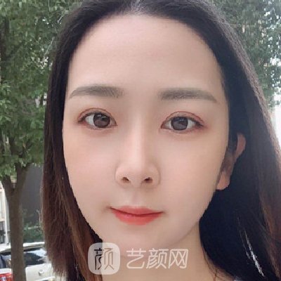 郑州集美做双眼皮怎么样?医院招牌实例曝光