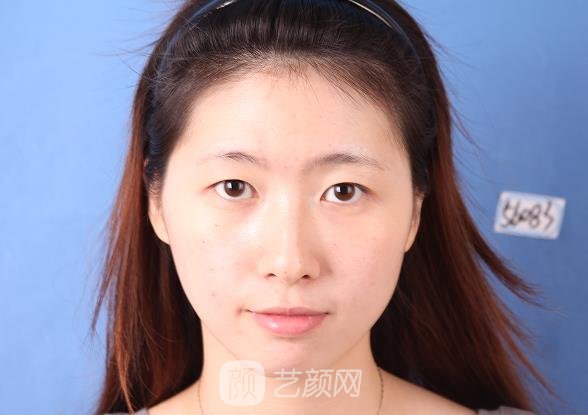 西安晶肤医疗美容医院割双眼皮怎么样？90天体验实例展示