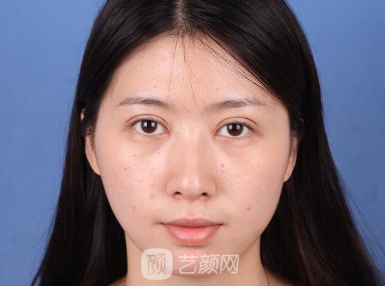 西安晶肤医疗美容医院割双眼皮怎么样？90天体验实例展示