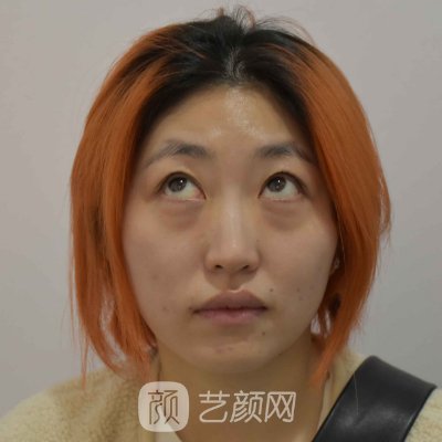 东莞市人民医院整形科去眼袋成果怎么样?亲身体验实例分享