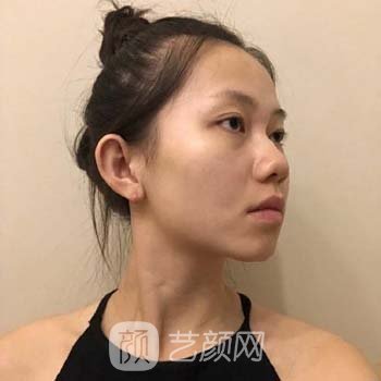 孟春丽隆鼻实例，想要让鼻子变美一些，其实并不难