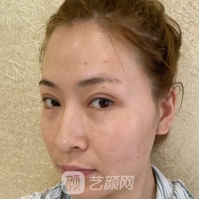 成都八大处玻尿酸面部填充怎么样?医院招牌实例展示