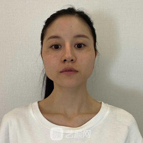 上海伊莱美李湘原下颌角实例展示|成果自然无痕