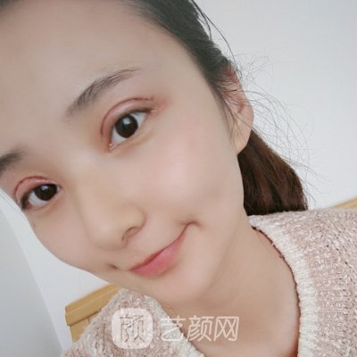 上海伊莱美朱迪双眼皮怎么样?亲身体验实例一览