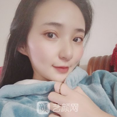 上海伊莱美朱迪双眼皮怎么样?亲身体验实例一览