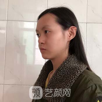 南京曹海峰做鼻子实例，术后隐形自然，随便揉捏也没事