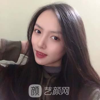 南京曹海峰做鼻子实例，术后隐形自然，随便揉捏也没事