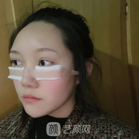 郑州美诗沁整形医院正规吗?医院招牌祛眼袋实例公开