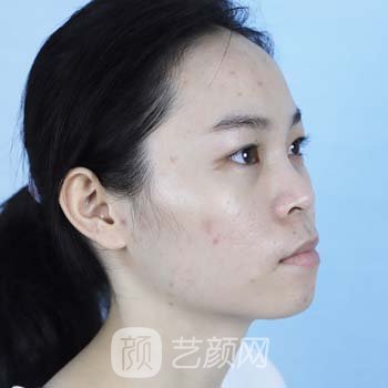 南阳三医院整形美容医院光子嫩肤怎么样？医生介绍+实例