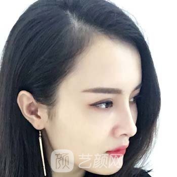 王彦进隆鼻实例，天然的妈生鼻简单塑造，美美哒