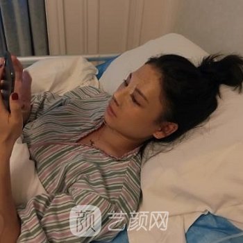 罗延平隆鼻实例，术后两个月变成小仙女，超美腻