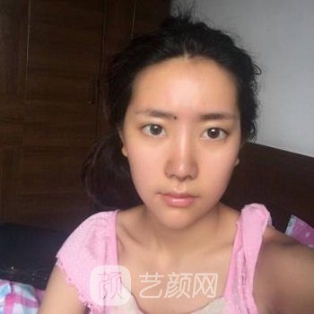 李健隆鼻实例，鼻子款式自然而不失精致、美艳