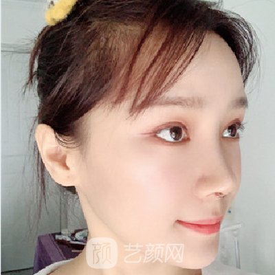 长沙美莱邹俊锋隆鼻实例出炉｜成果自然美观