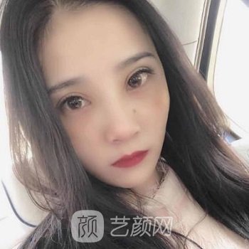 昆明工人医院整形美容科怎么样？口碑点评+自体软骨隆鼻实例